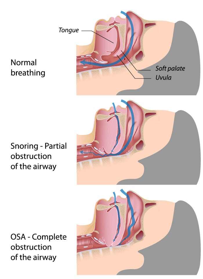 Obstructive Sleep Apnea
