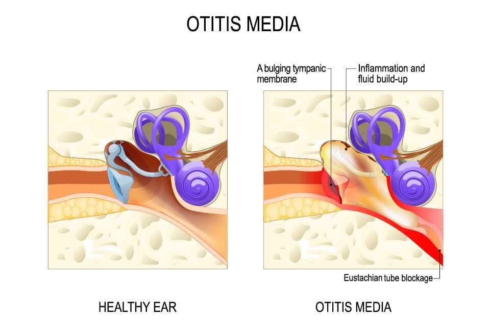 Pediatric Ear Infections