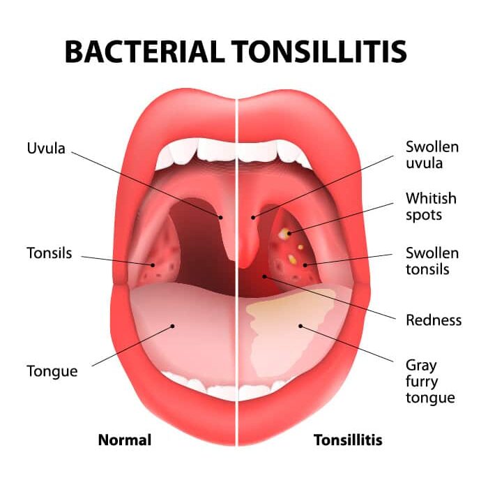 Bacterial Tonsilitis