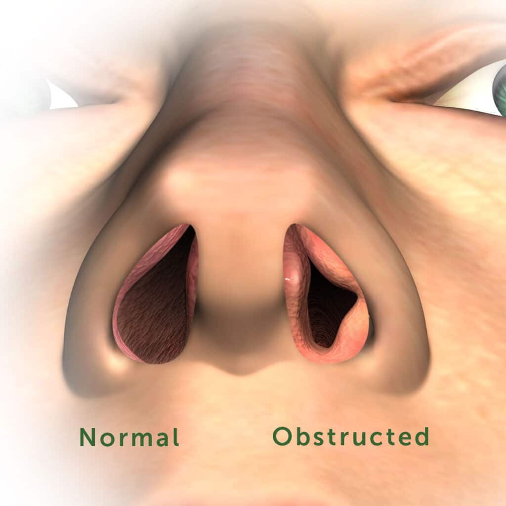 nasal obstruction