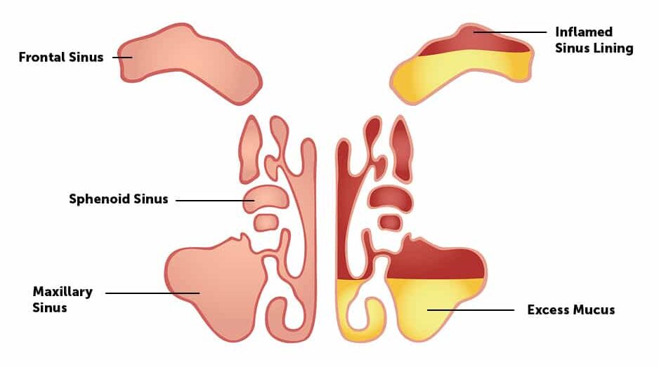 sinuses-e1684187131638