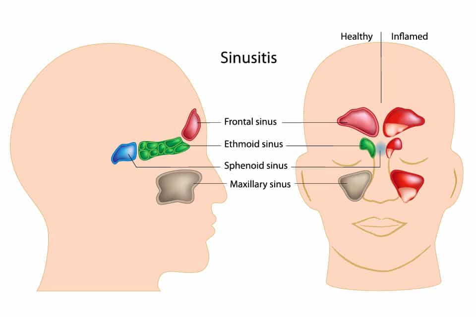 Sinusitis Cross Section