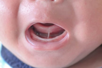 tongue tie