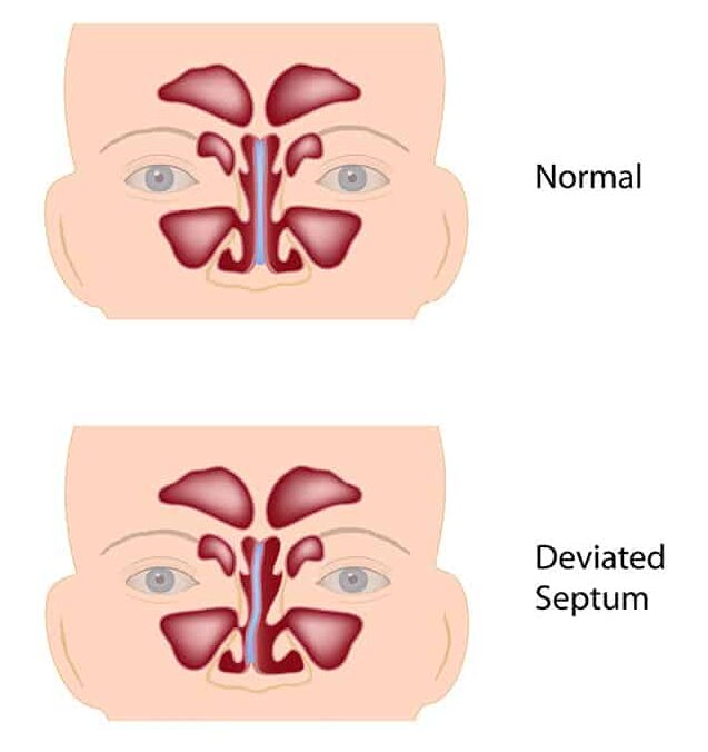deviated septum nostrils