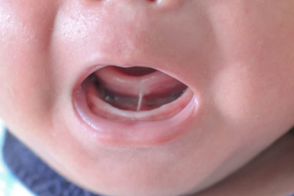 What Is Tongue-Tie in Infants, and Can It Affect Breastfeeding?